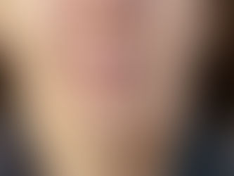 What Causes Dimpling In The Chin?