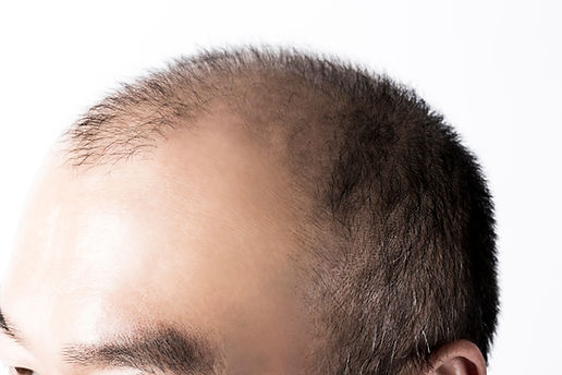 Androgenetic Alopecia