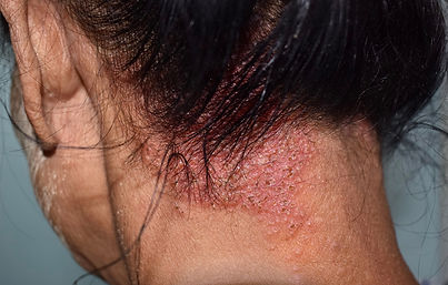 seborrheic dermatitis