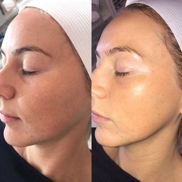 dermaplaning.jpeg