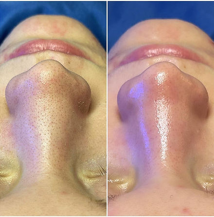 HF_Blackheads_skin_128664881_1314477262233461_6813124416199020990_n (1) (1).jpg