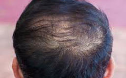 hair loss
