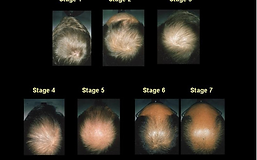 hair loss