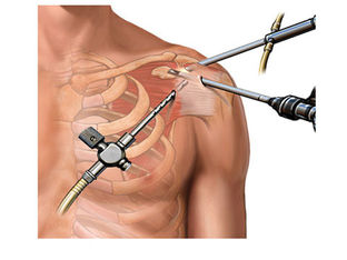 Get Rid of the Shoulder Pain with Arthroscopy: Planning, Procedure and Recovery