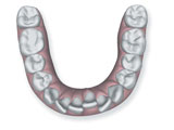 Crowding Treatment Invisalign - Andover