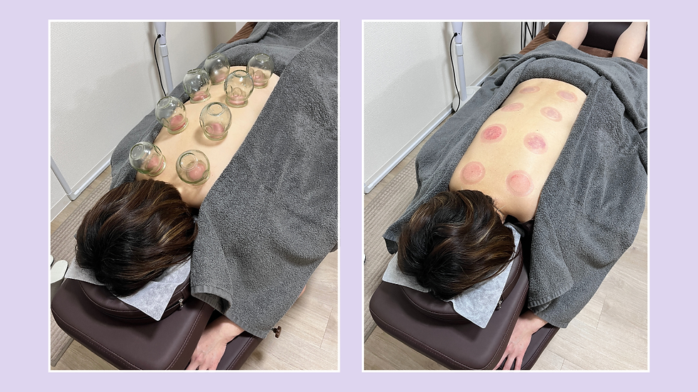市川のはり灸sueru&YOGAです。
吸い玉(カッピング)の効果・跡が残る理由・頻度・注意点を、よくある質問形式で鍼灸師が解説します。