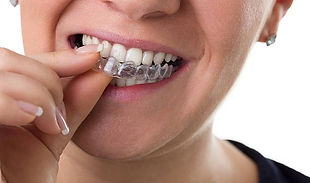 Invisaligne con lk dental.jpeg