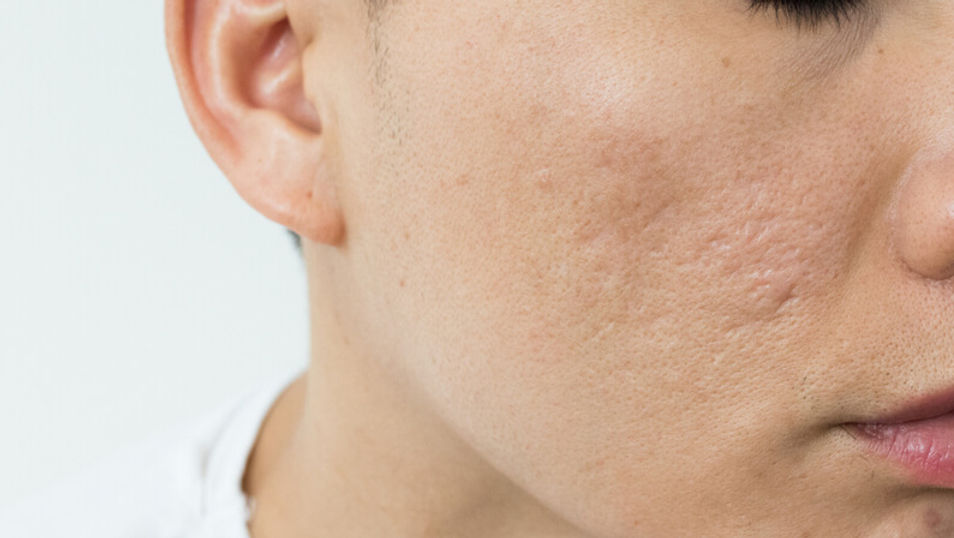 ice-pick-scars_edited.jpg