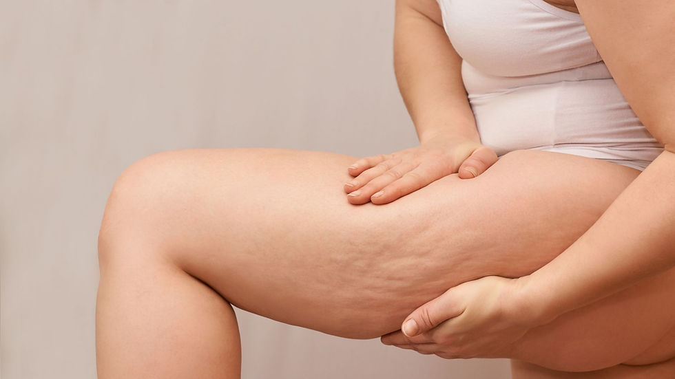Celulite, flacidez ou lipedema: como saber a diferença?