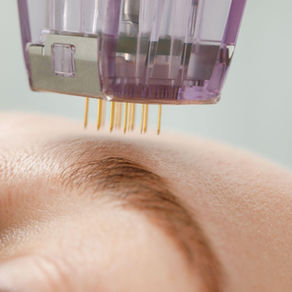Mulher recebendo na pele o tratamento Dermapen 4