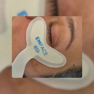 Emface para a área dos olhos: tecnologia de última geração para uma das regiões mais delicadas do rosto