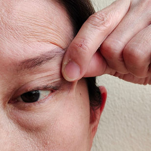 Qual o melhor tratamento para flacidez facial sem cirurgia?