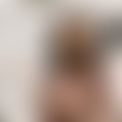 CoolSculpting: Tecnologia avançada para redução de gordura localizada