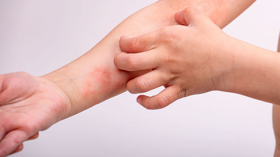 Fotografia de pessoa coçando o seu braço na região com Dermatite Atópica