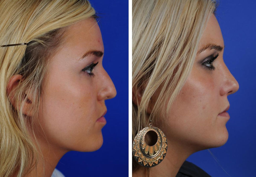 COFPS Adolescent Rhinoplasty Lateral 3.jpg
