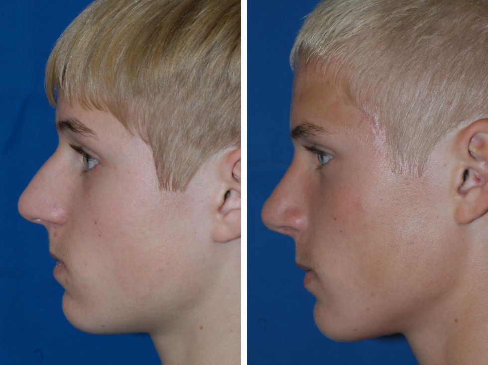 COFPS Adolescent Rhinoplasty Lateral 2_0.jpg