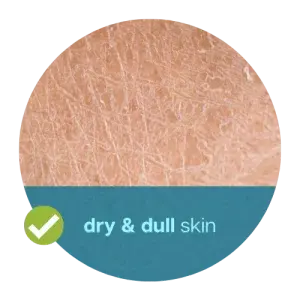 profhilo-for-dry-skin