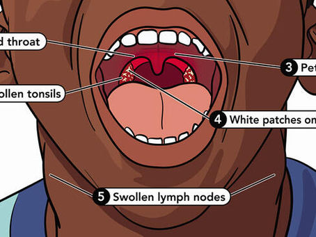 BETA (STREP-A) ENFEKSİYONU NEDİR, NASIL ÖNLEM ALINIR?