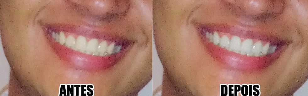 Técnica de clareamento dentário