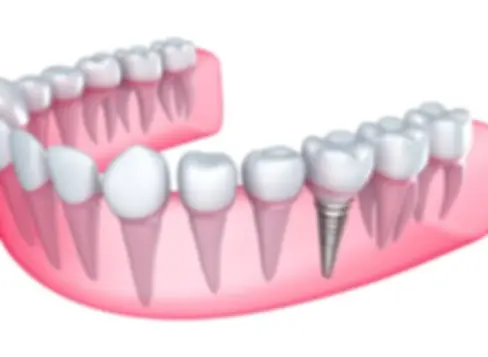 depositphotos_10111180-stock-illustration-dental-implant-in-the-gum.jpg