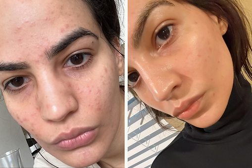Virtual Acne Client Before + After.png