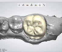 A detailed digital rendering of a dental crown being designed using CAD software, showing precise anatomical features on a virtual tooth preparation.