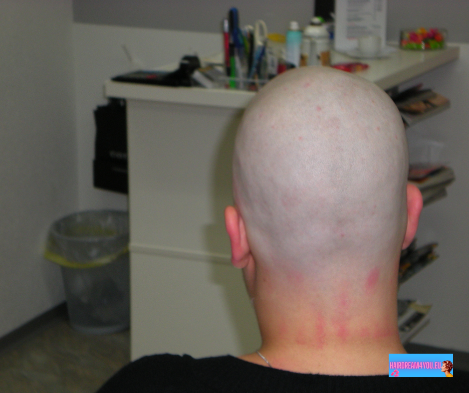 Thumbnail: Berta needs a head shave!