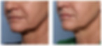 Before & After the ONDA Pro Treatment