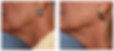 Before & After the ONDA Pro Treatment