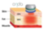 view of the ONDA PRO Precision Giga Wave works on skin structure