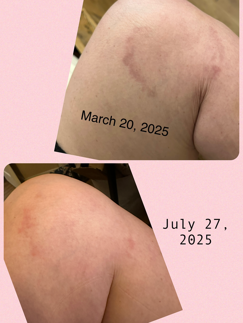Granuloma annulare - an outward manifestation of my internal inflammation. As you can see its nearly gone... that one had been with me for around 5 years!