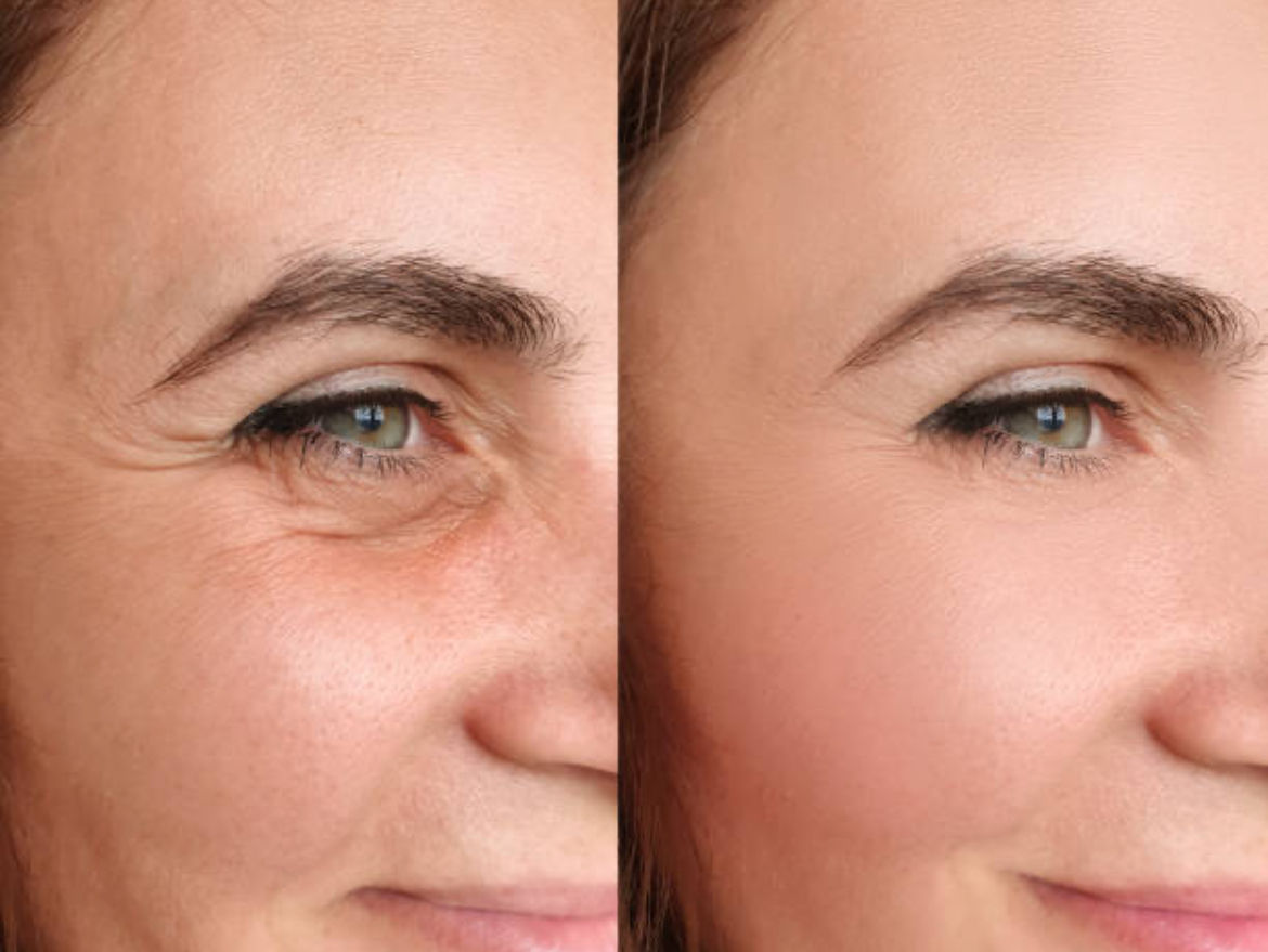 Skin boosters are injectables that improve skin texture, elasticity, hydration and overall appearance. Skin booster treatment involves injecting hyaluronic acid which is a soft, gel-like substance under the skin, which improves the skin's elasticity, firmness and radiance giving an overall GLOW.