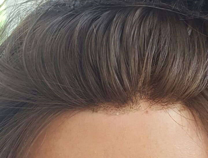 Protesi-capelli2