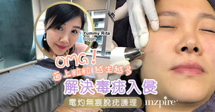 【OMG!面上粒粒 越生越多】解決毒疣入侵 電灼無痕脫疣護理