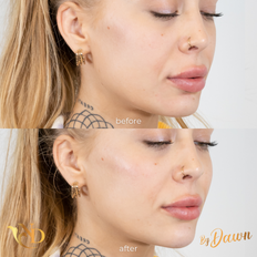 Cheek Filler