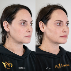 Cheek Filler
