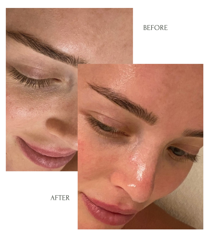 Transform Your Skin with a Hydrafacial at Idan Med Spa Now in San Francisco & Encino