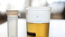 Πρωτεϊνουρία, Λευκωματουρία - Αλβουμινουρία