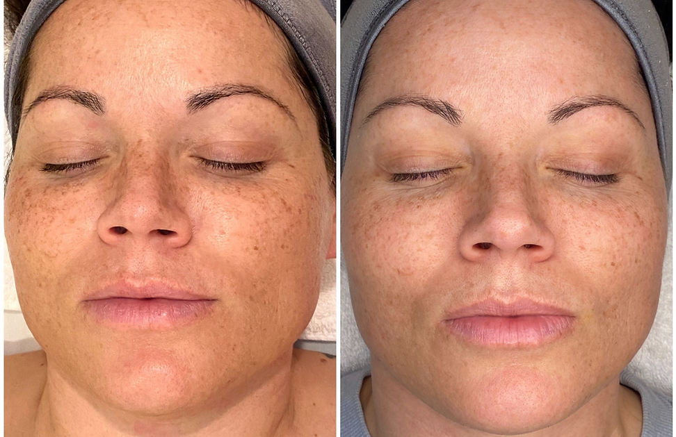 Hyperpigmentation Before and After Brandy Lester Aesthetics