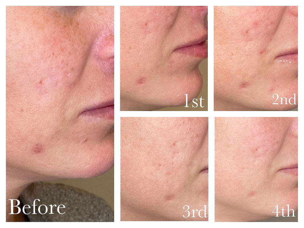 Hyperpigmentation, Scar Revision, Pore Size Before and After Brandy Lester Aesthetics