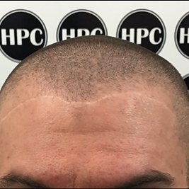 Dr. Andrea echeverry Scar Camouflage Fac