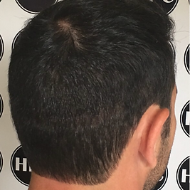 Scar Camouflage Multiple scars. after 2.