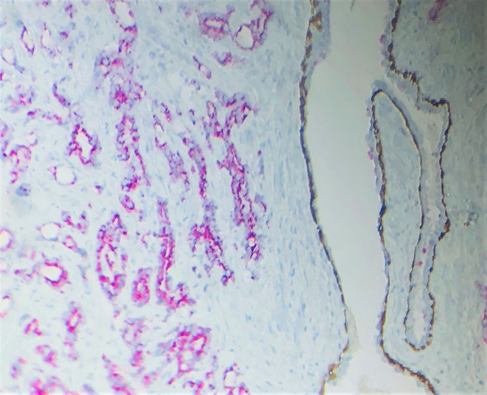 Thumbnail: Prostate Cancer panel