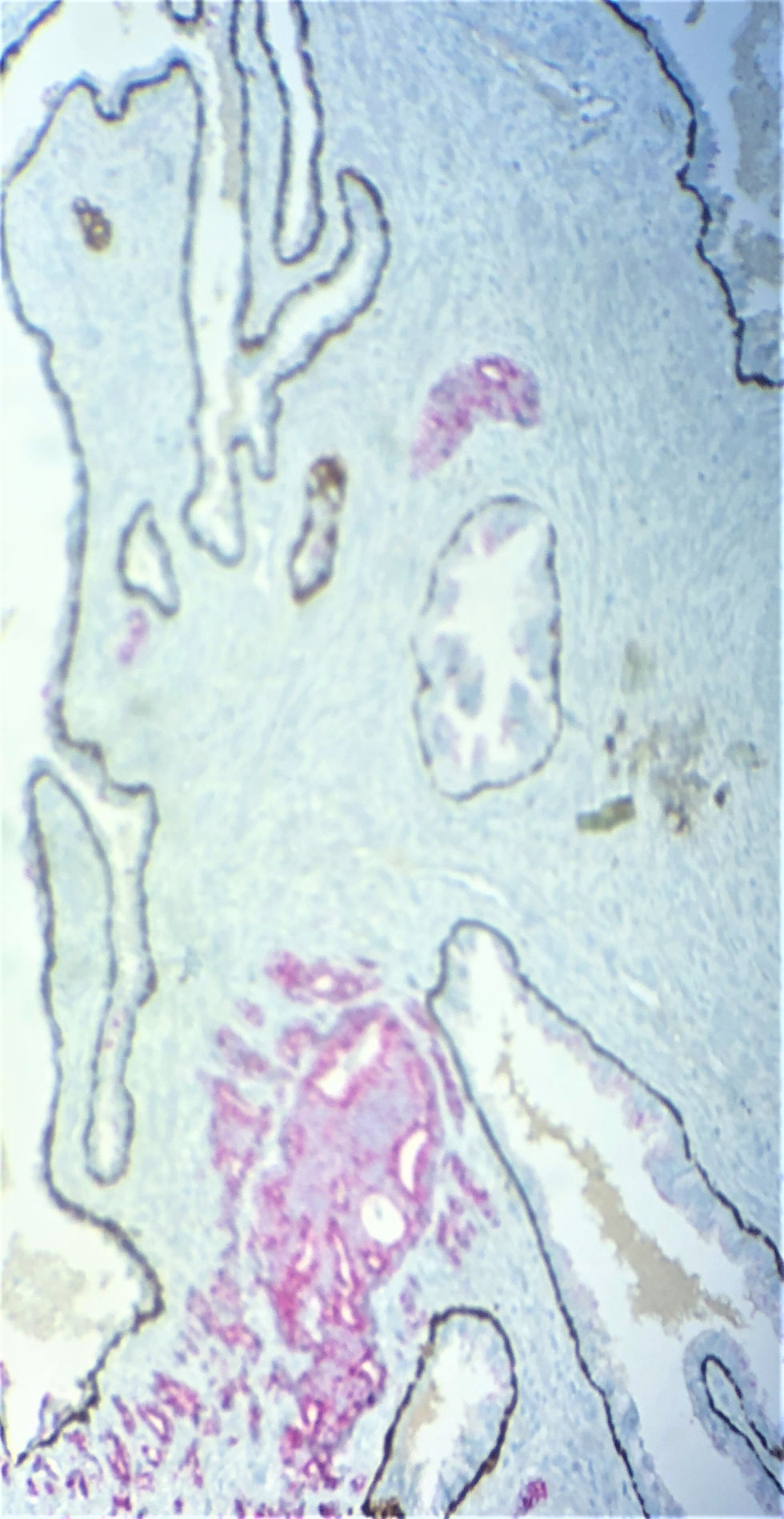 Thumbnail: Prostate Cancer panel