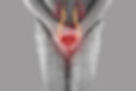 man in pain with urinary stones