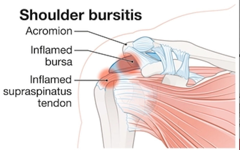 shoulder bursitis location