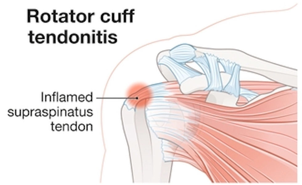 Supraspinatus tendonitis