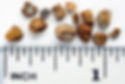 kidney stones with ruler