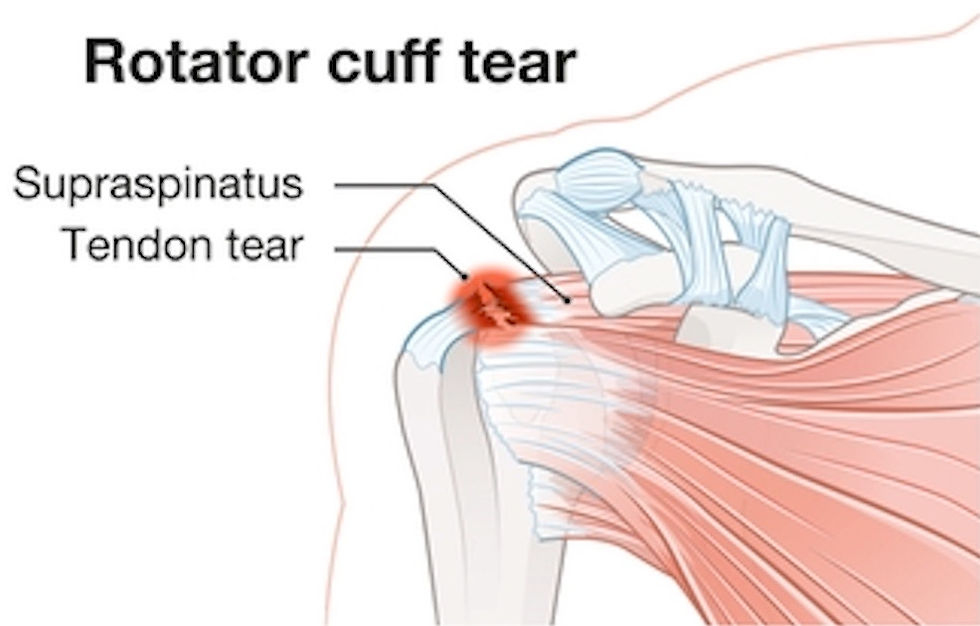 rotator cuff tear