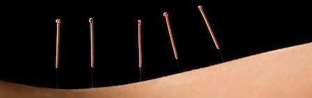 Acupuncture Effects Not Just Psychological